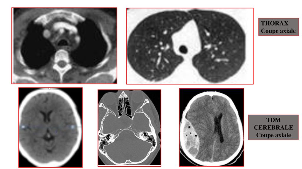 TOMODENSITOMETRIE TDM OU SCANNER OU CT SCAN ppt télécharger